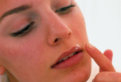 Простуда на губе: народные рецепты избавления от губной лихорадки