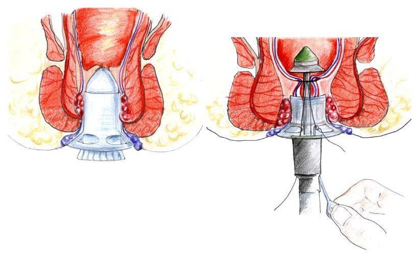 Лечение геморроя фото