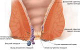 Геморрой схема фото