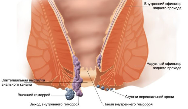 Геморрой схема фото