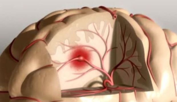 болезнь инсульт причины