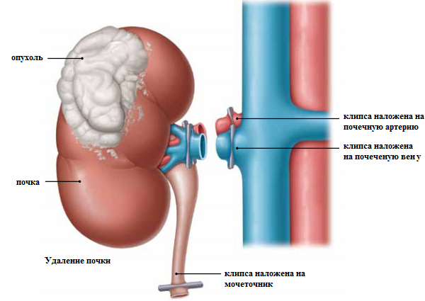nefrektomia-pochki