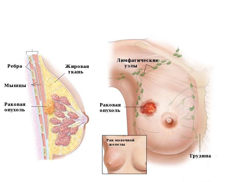 Рак молочной железы