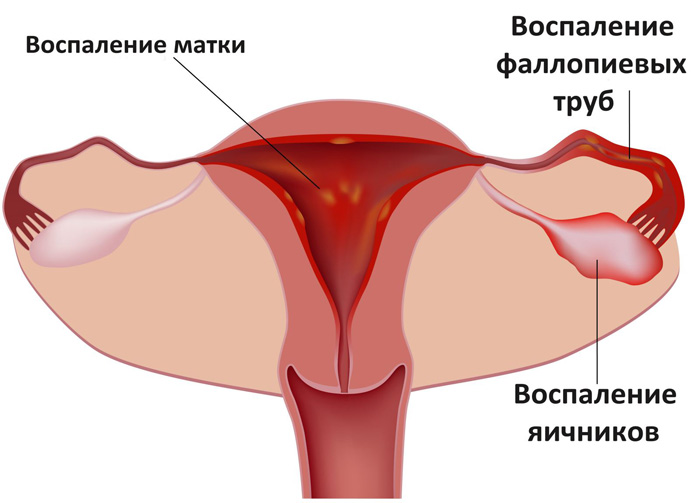hronicheskij-endometrit-simptomy-i-lechenie