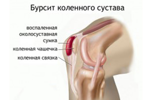 bursit-kolennogo-sustava-1