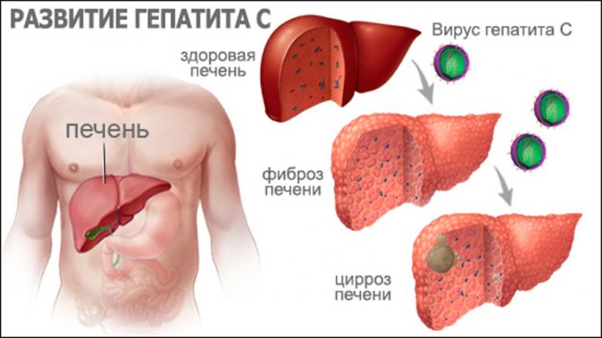 Как лечится гепатит С?