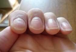 Почему ногти становятся волнистыми?