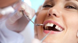 Зубные имплантаты для Вас