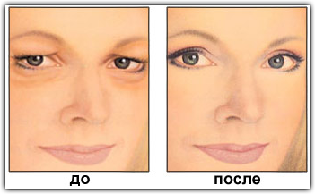 blefaroplastika-verhnih-vek