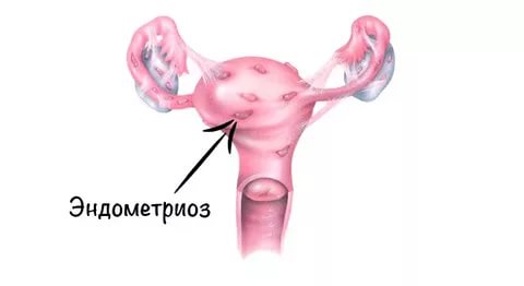 Патогенез, признаки и лечение миомы матки