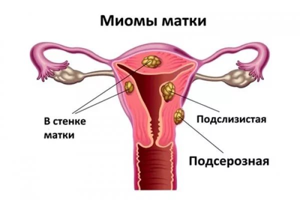 Патогенез, признаки и лечение миомы матки