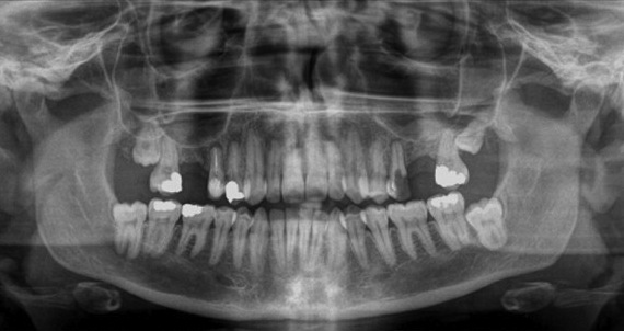 Преимущества и недостатки панорамного снимка зубов