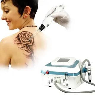 Как работает аппарат для лазерного удаления татуировок?