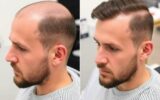 Пересадка волос для мужчин: что важно знать перед решительным шагом